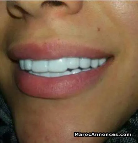 Blanchiment / snap on smile agadir - الدار البيضاء
